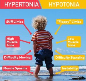 Types of muscle tone